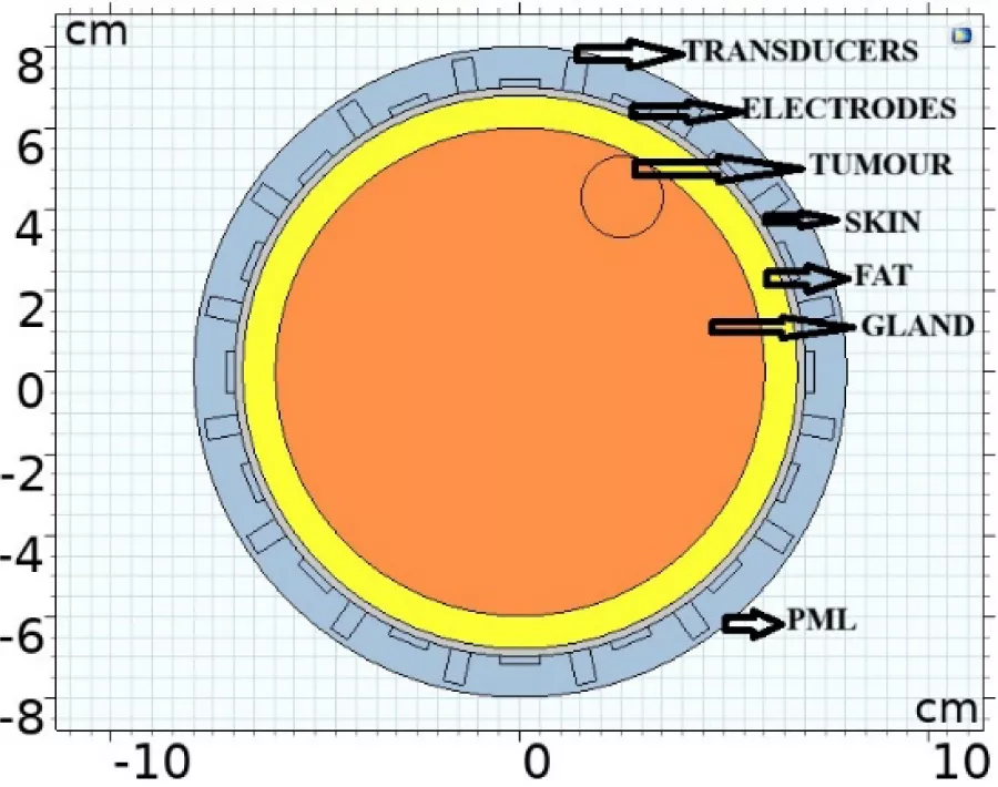 Advanced Breast Tissue Tomography via Anatomical Prior-Informed Electrical Impedance Reconstruction